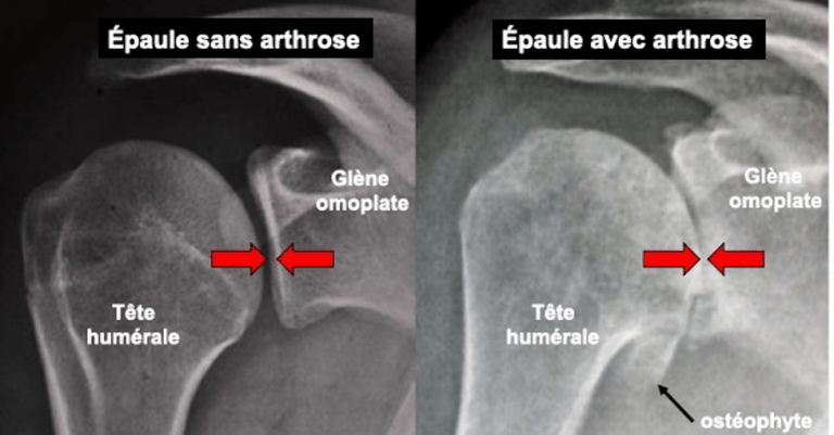 arthrose-de-l-paule-causes-sympt-mes-diagnostic-et-traitements