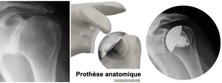 prothese epaule anatomique